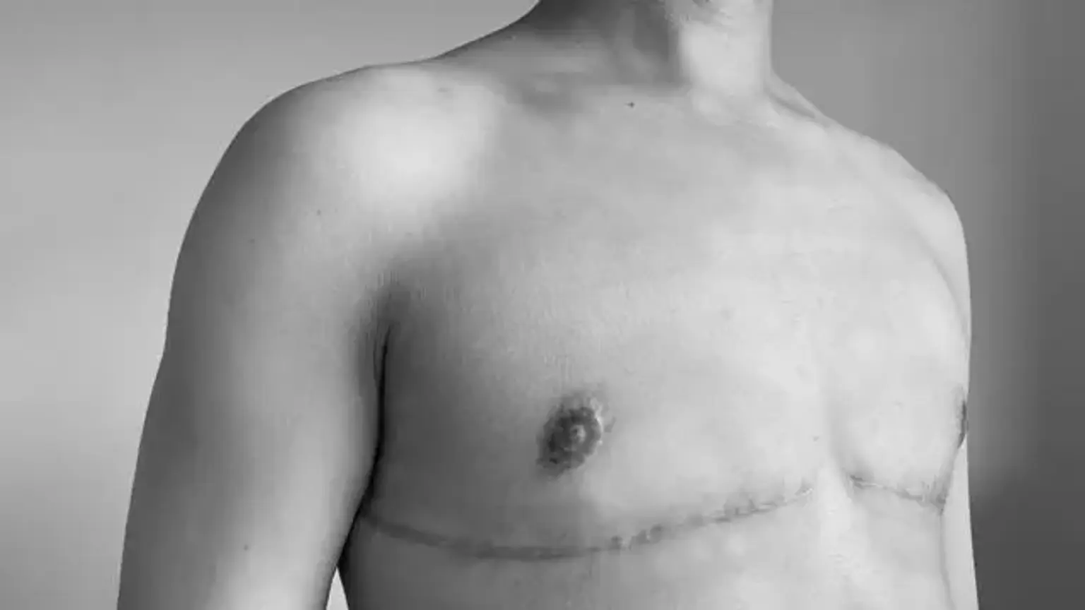 Chest Reconstruction Surgery