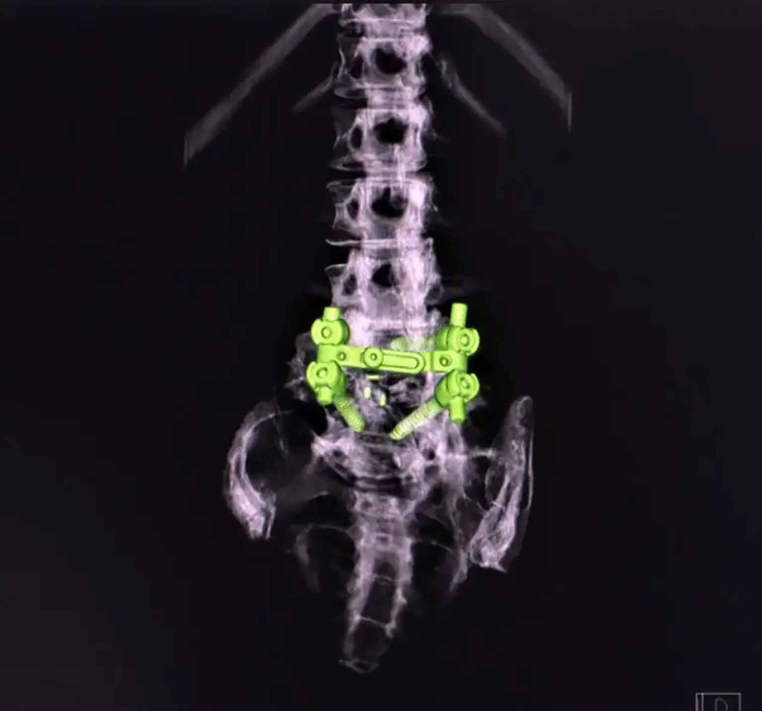 Anterior Lumbar Interbody Fusion