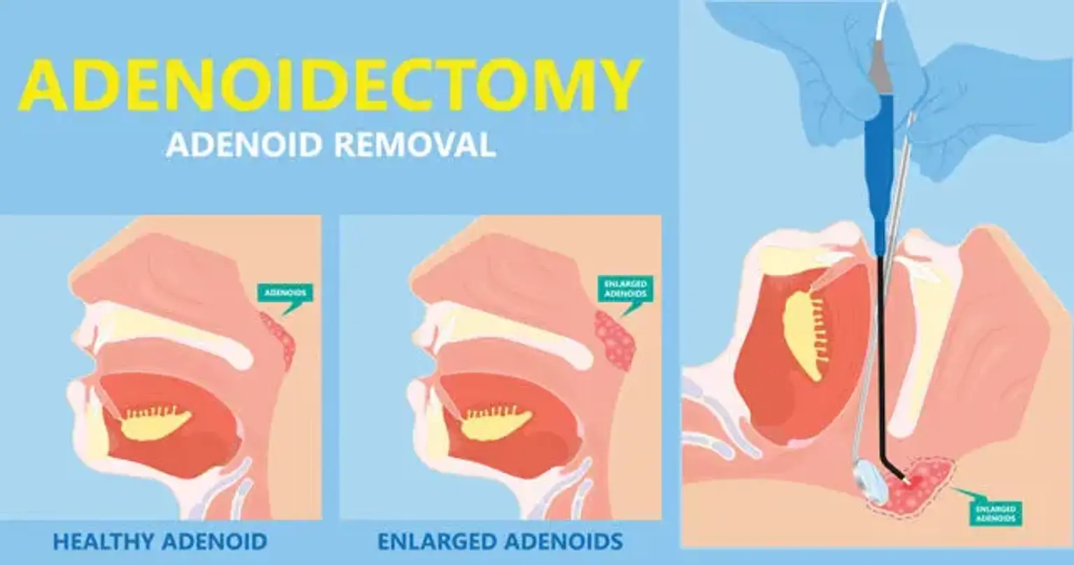 Adenoidectomy