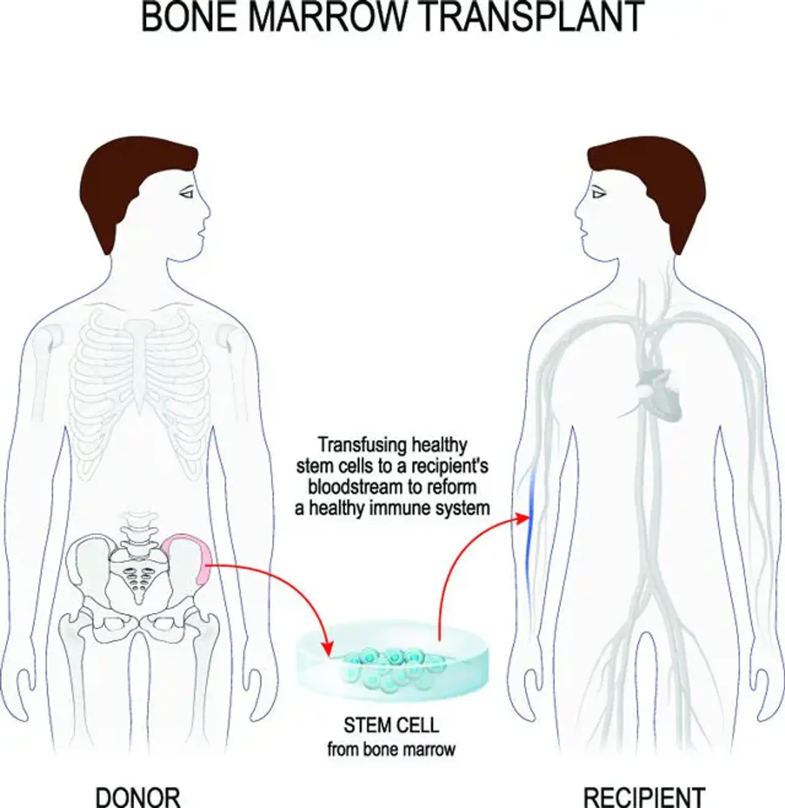 Transplantasi Sumsum Tulang