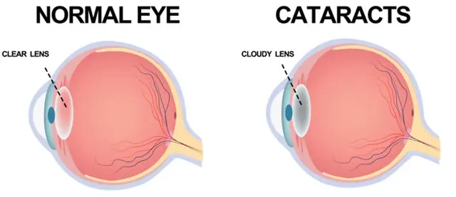 Cataract