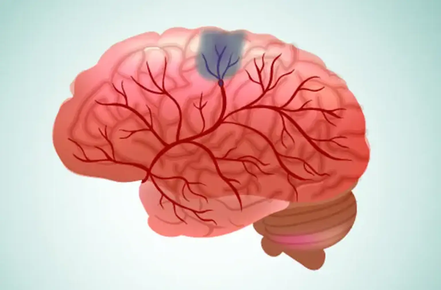 Cerebrovascular diseases