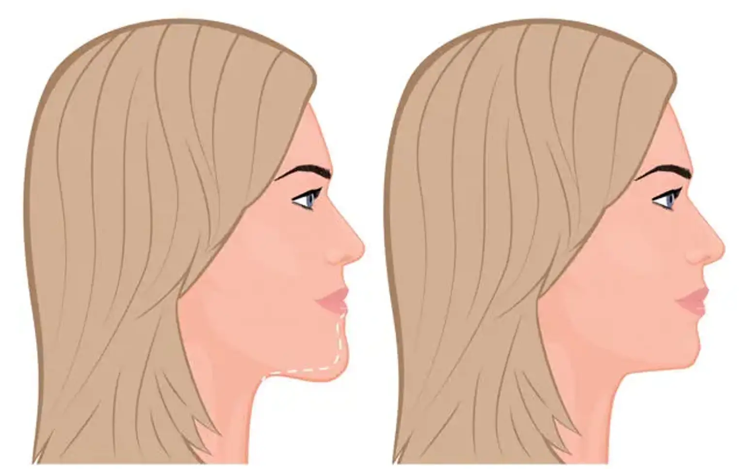 Chin Reduction