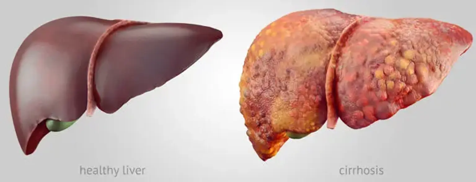 біопсія печінки