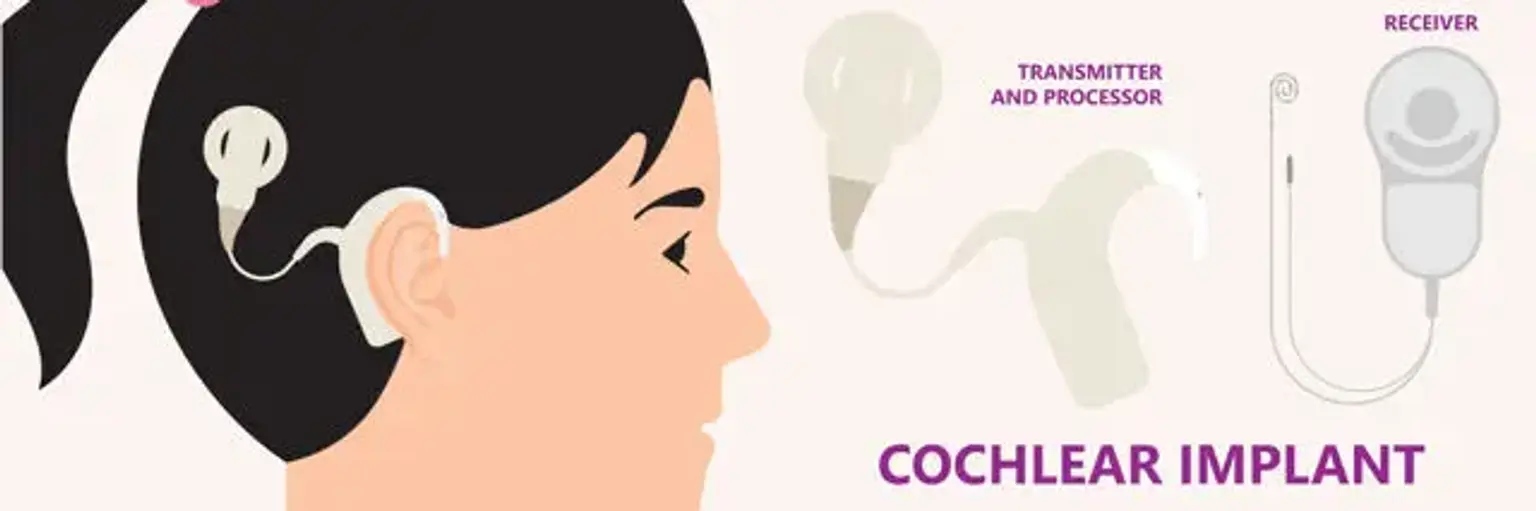 Cochlear Implants