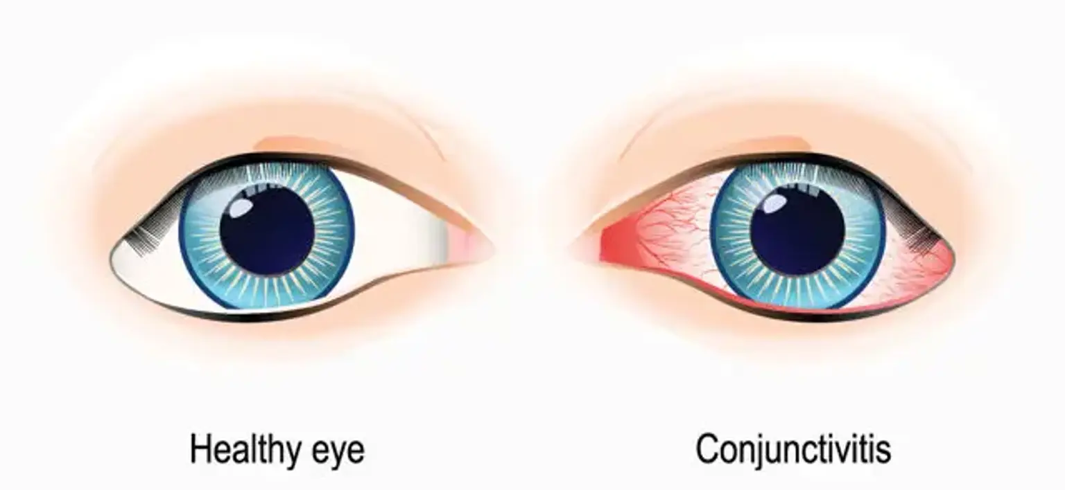 Conjunctivitis