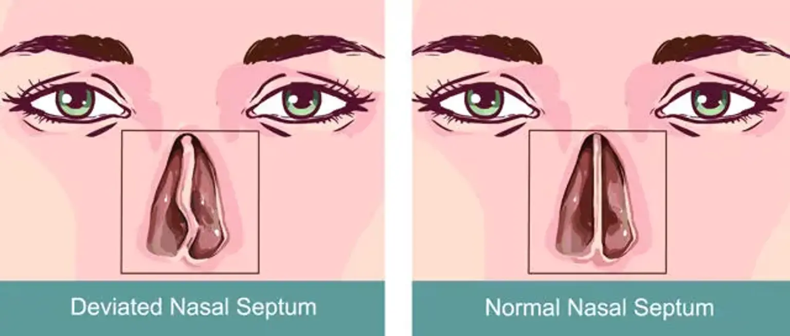 Deviated septum 