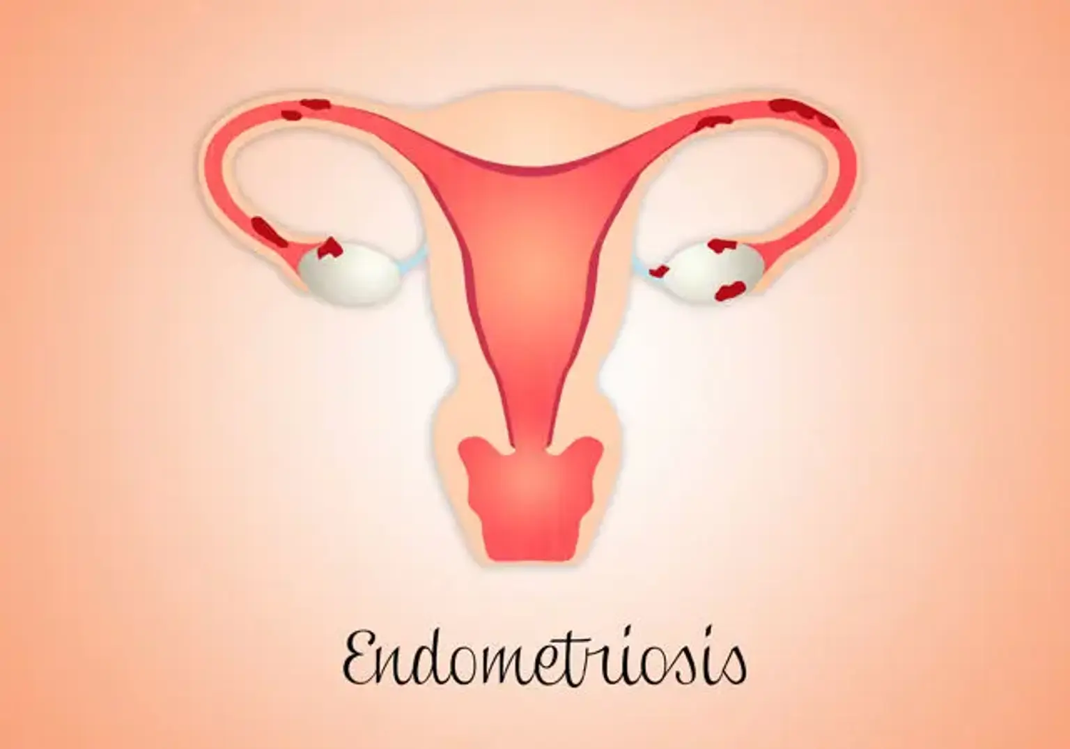 Endometriosis