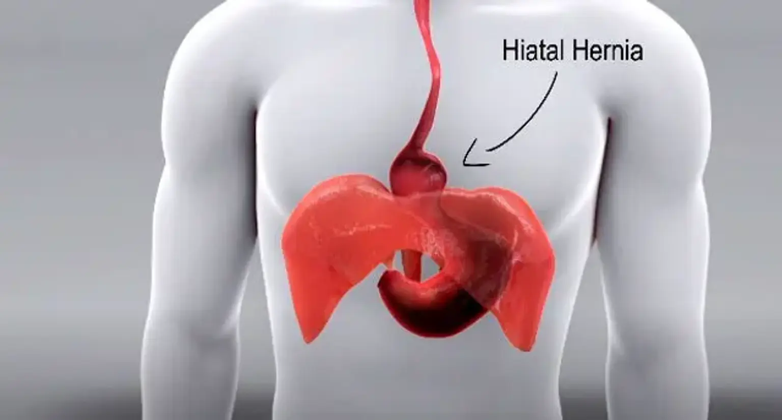 Hiatal Hernia