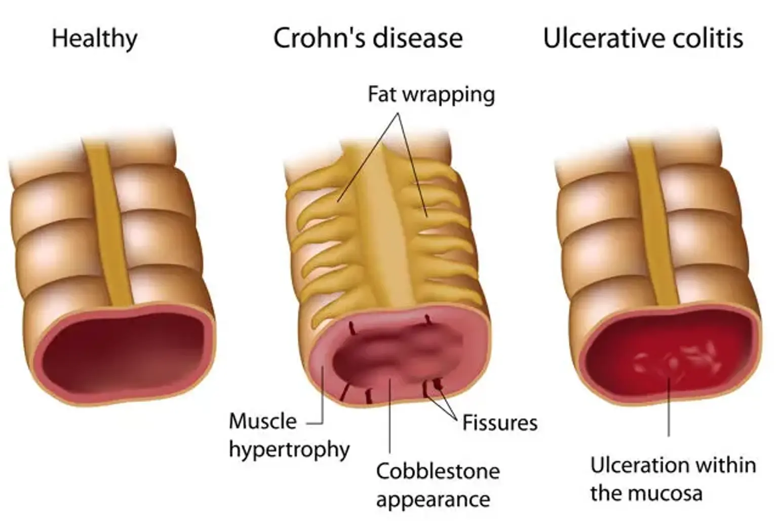 Types of Inflammatory Bowel Disease