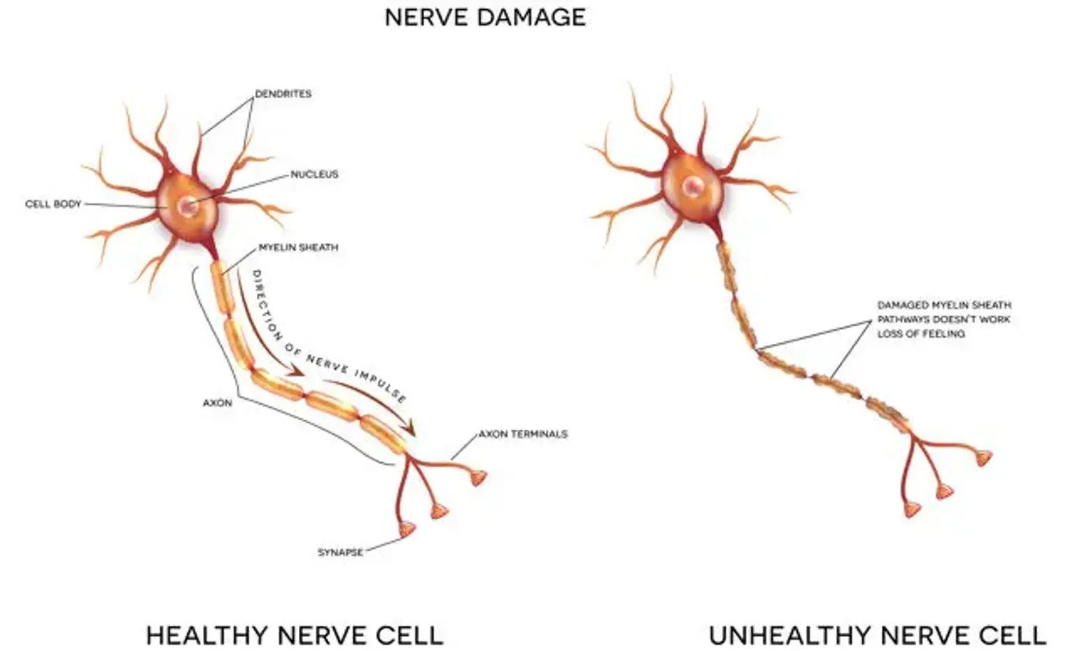 Neuropathy 