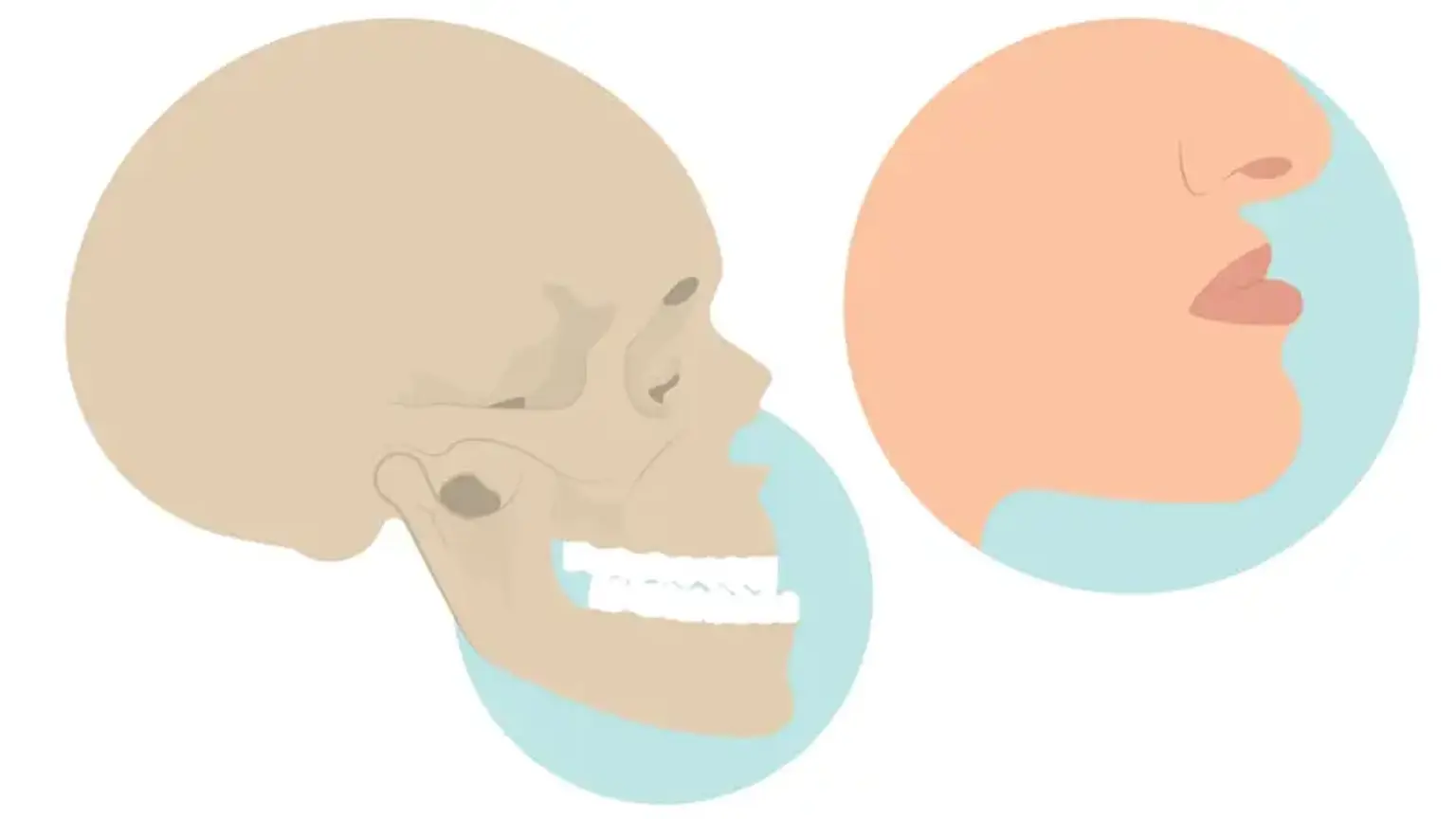 Osteotomy