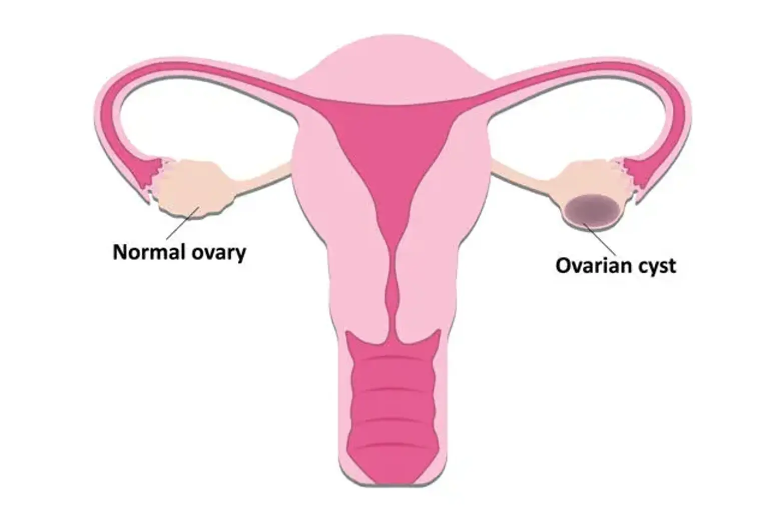 Ovarian Cyst