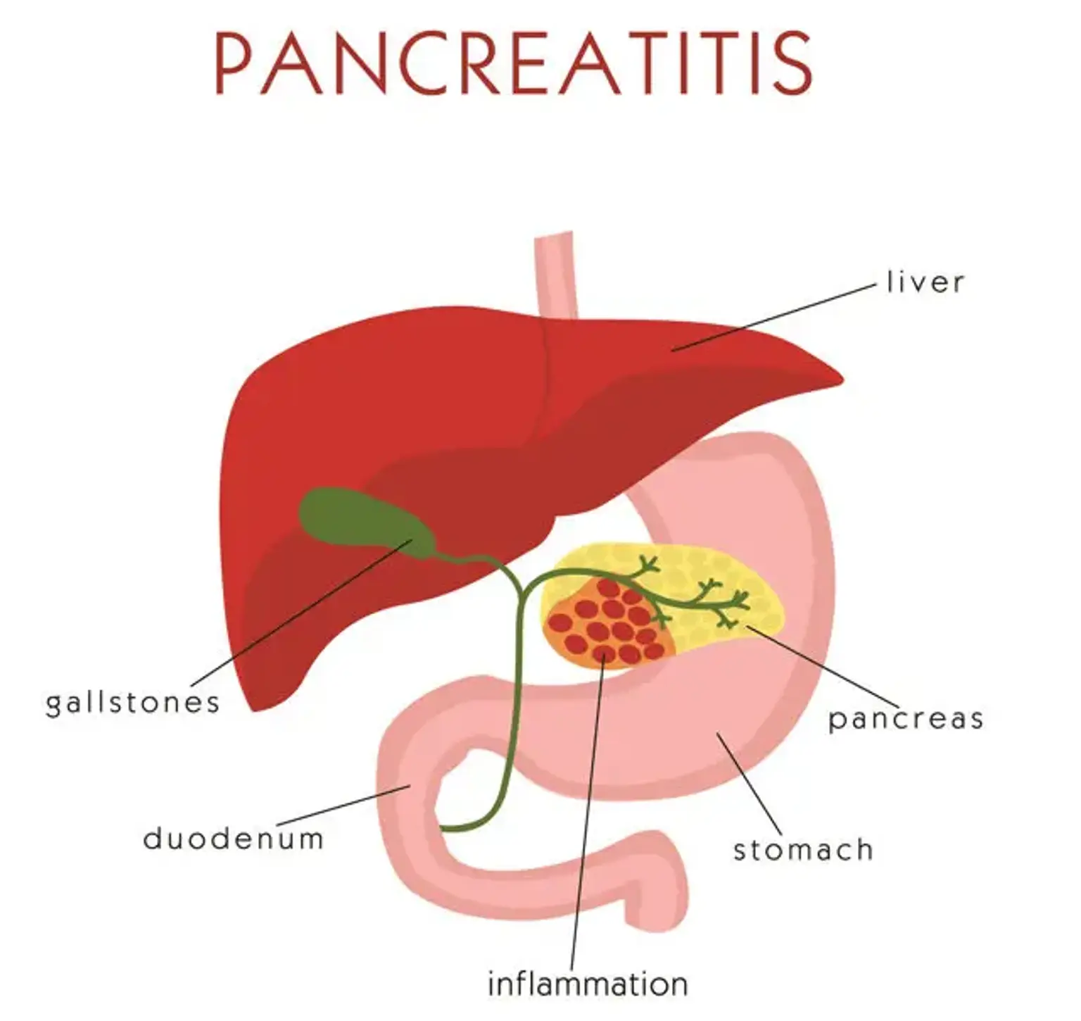 Pancreatitis