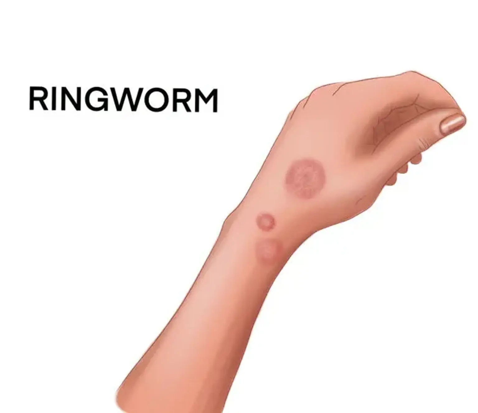 Ringworm