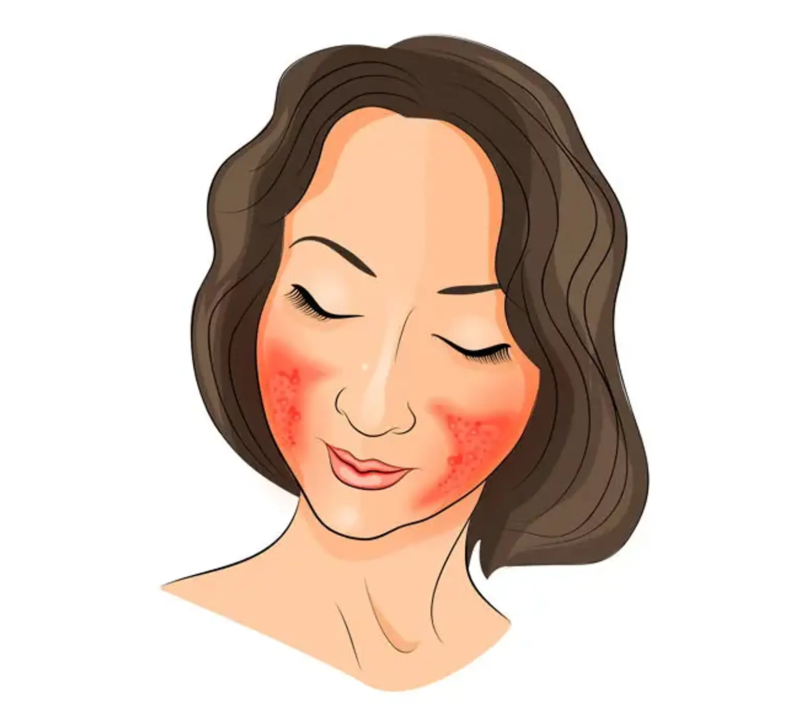 Rosacea