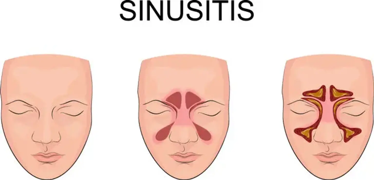 Sinusitis