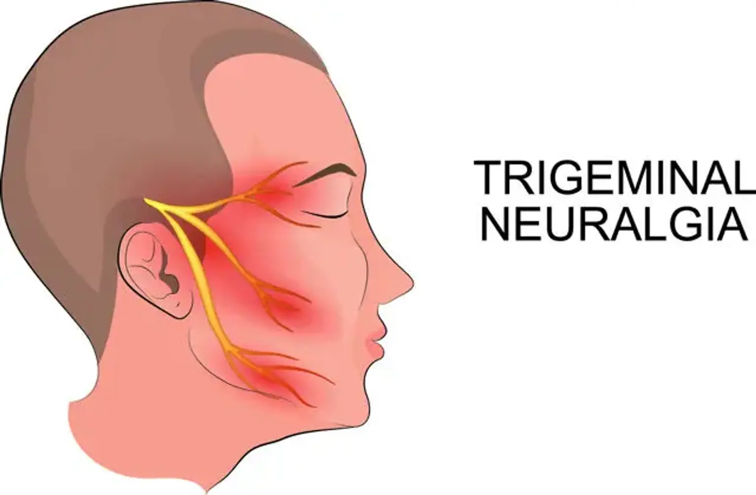 Trigeminal neuralgia