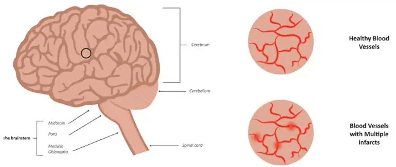 Vascular Dementia 