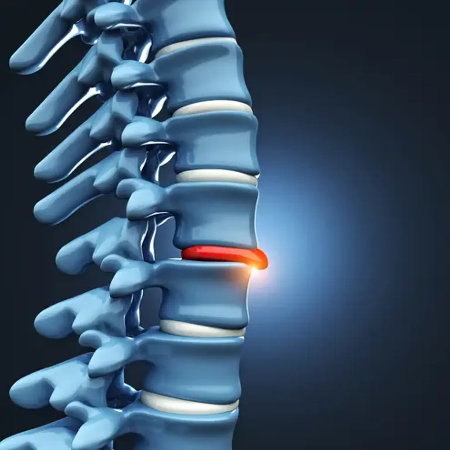 Lumbar Herniated Disc