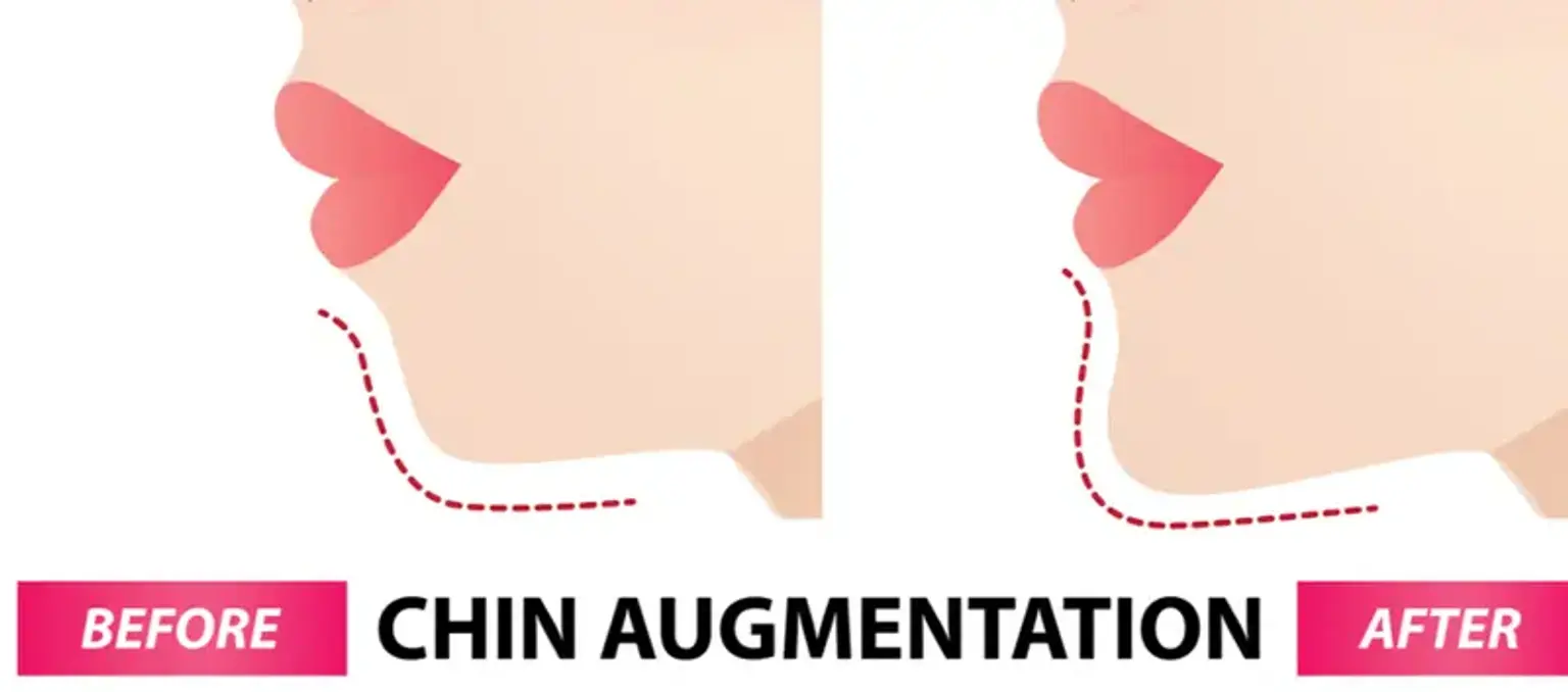 Front Chin Augmentation