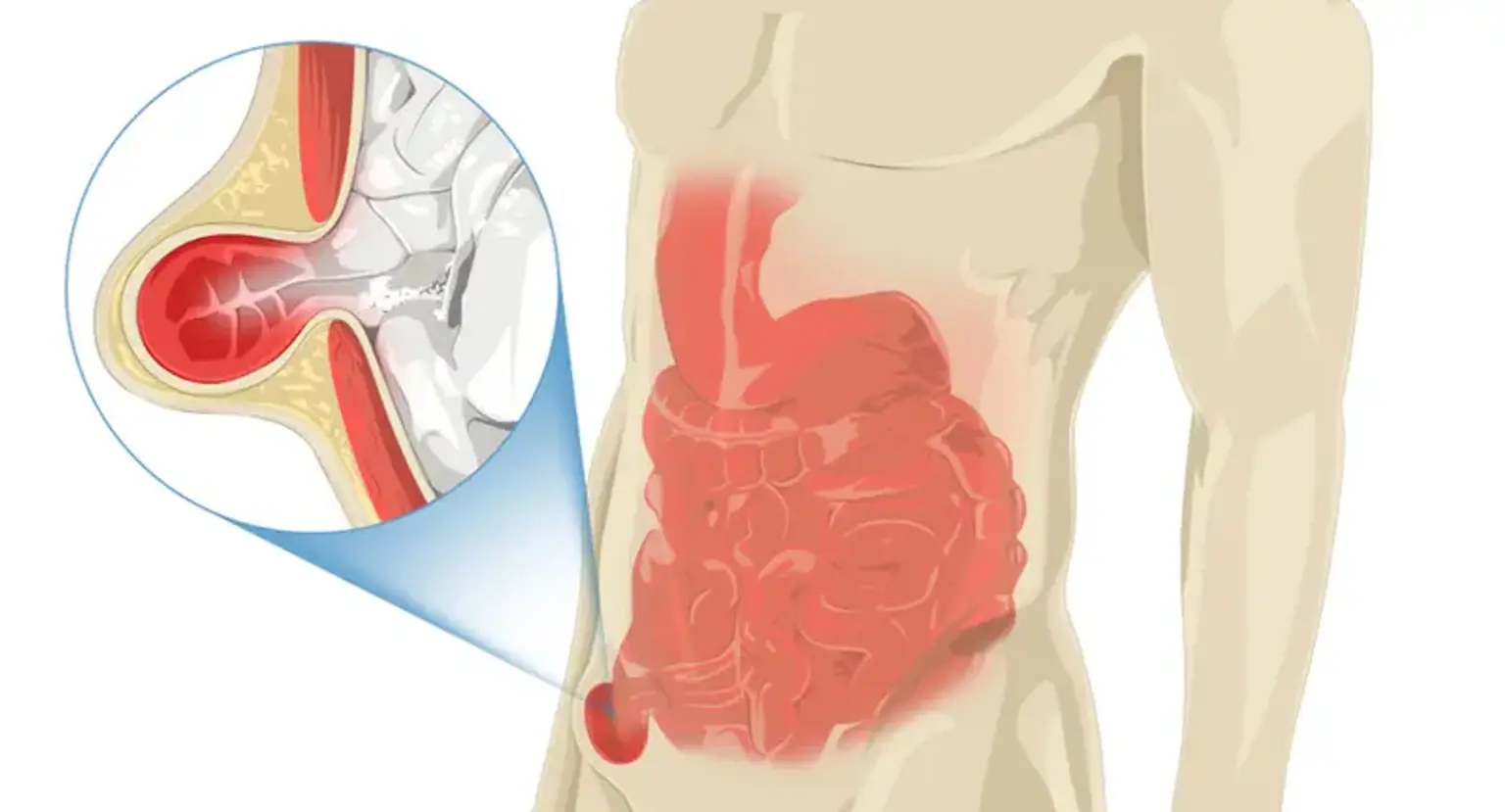 UL Inguinal Hernia