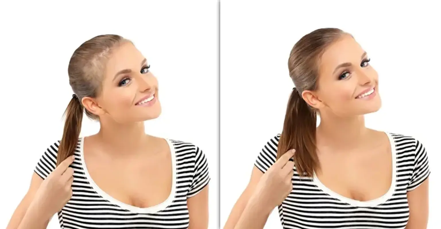 Fill Up Hair Grafting (Hair Loss in Woman)