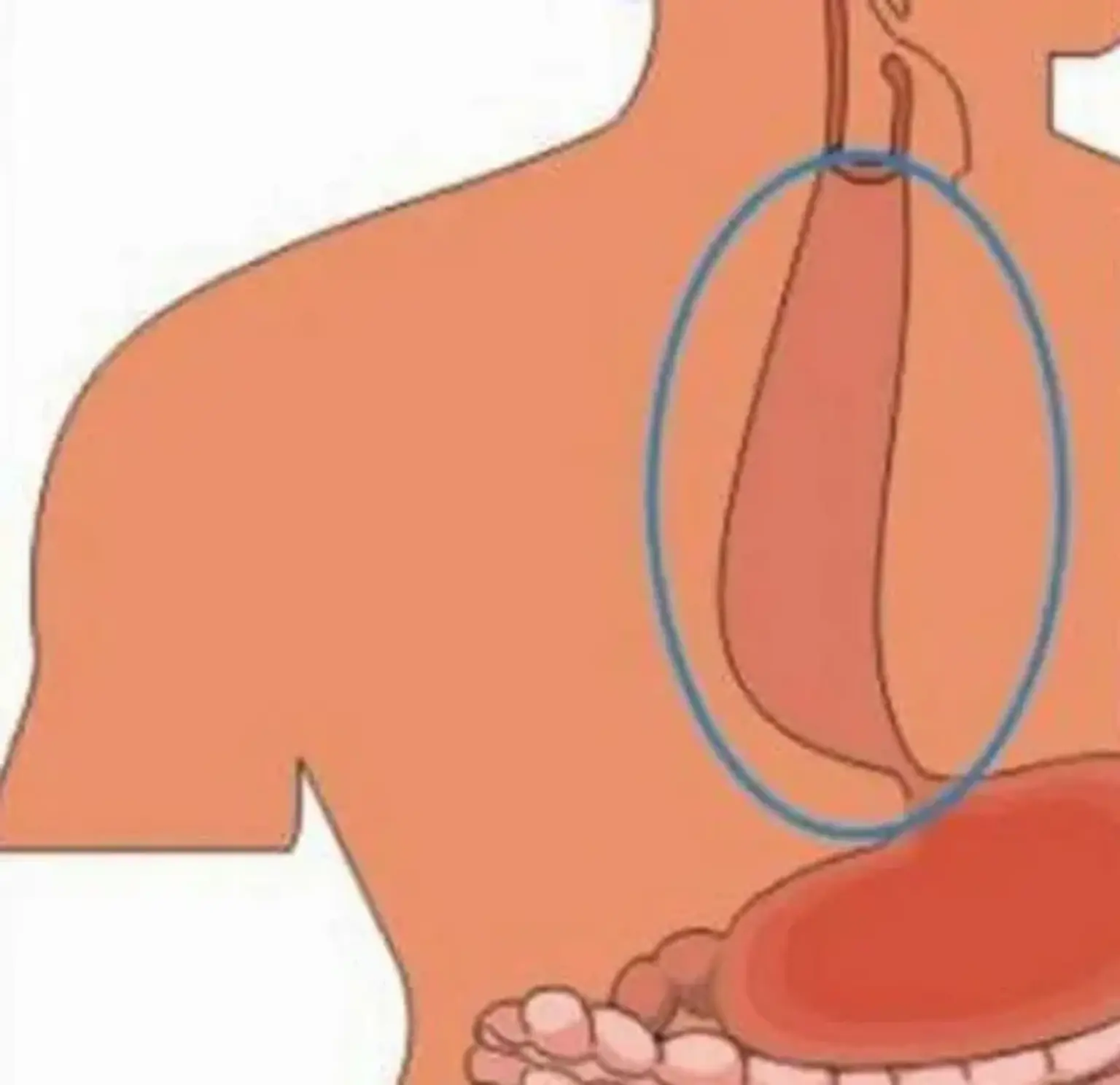 Esophageal achalasia