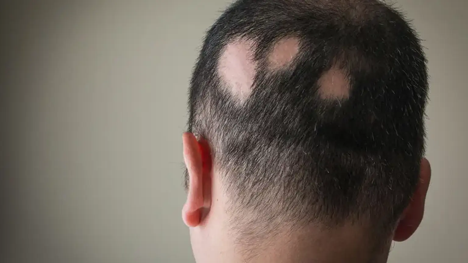 Alopecia areata