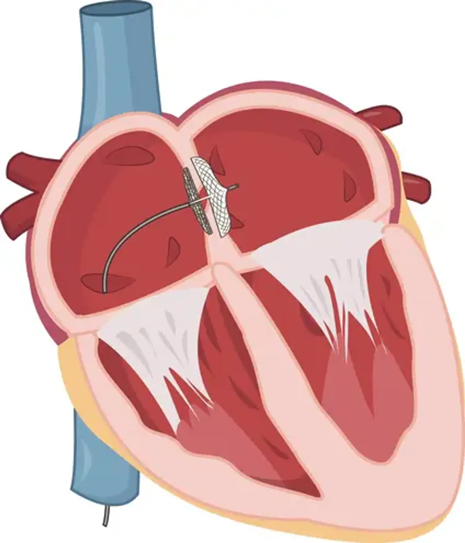 Device Closure of Atrial Septal Defect