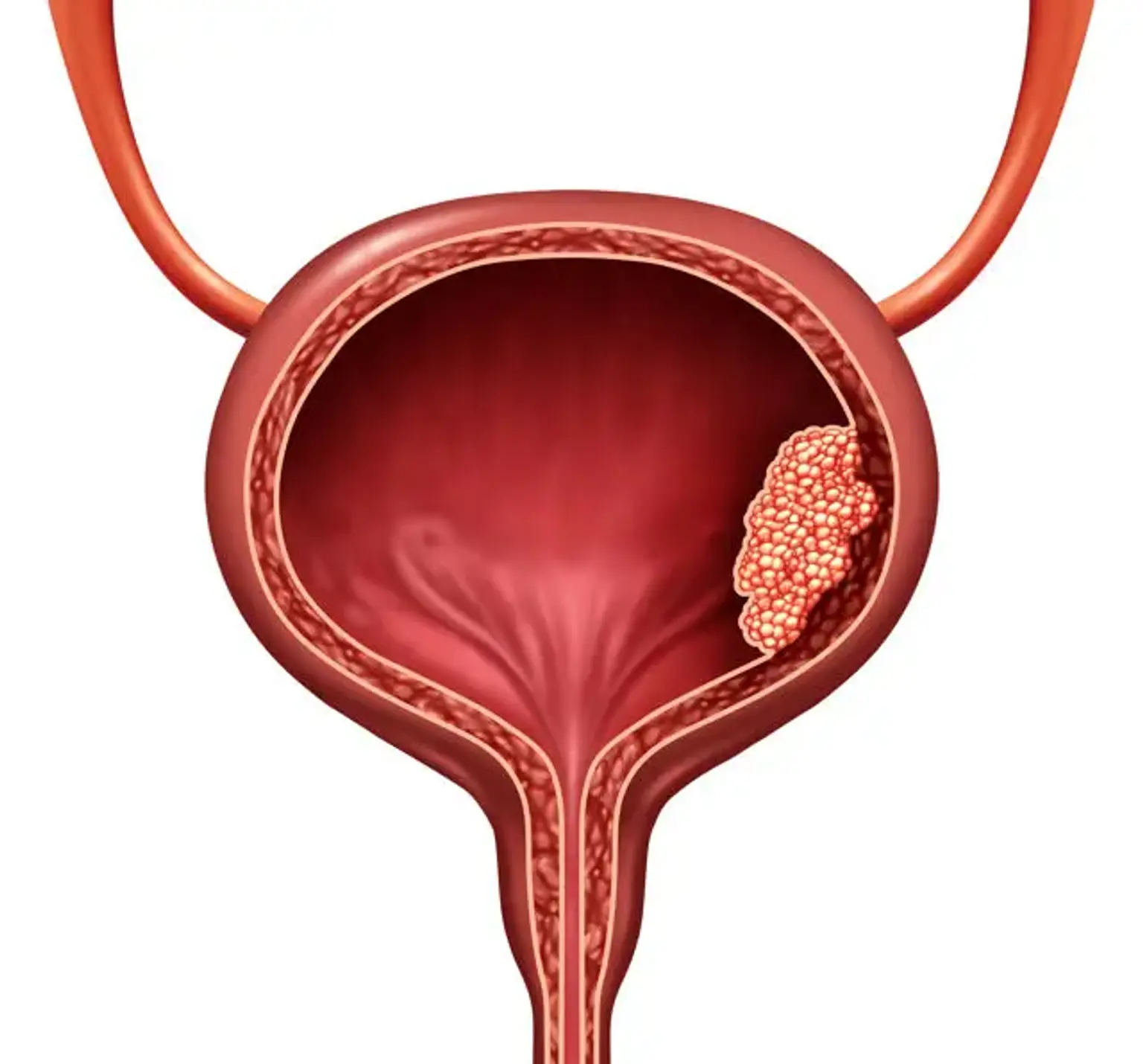 Datos sobre el cáncer de vejiga: puntos de vista de médicos expertos 