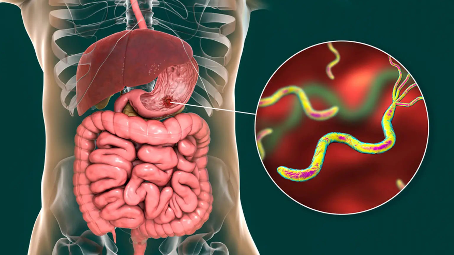 Stomach and duodenal diseases