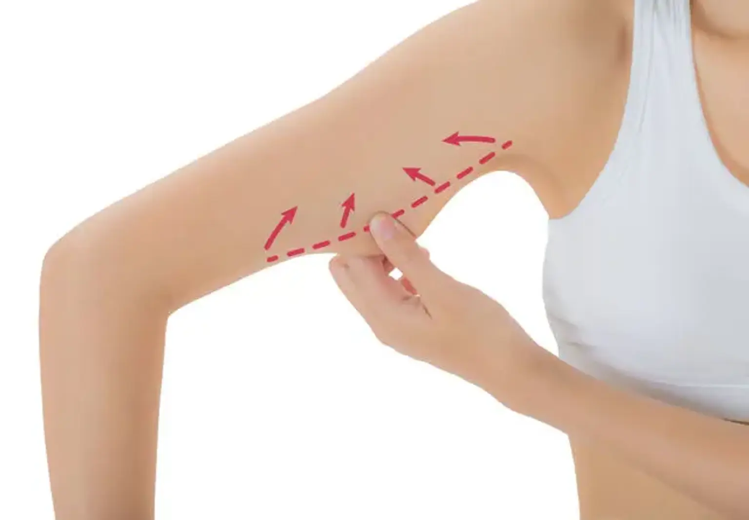 Arm liposuction