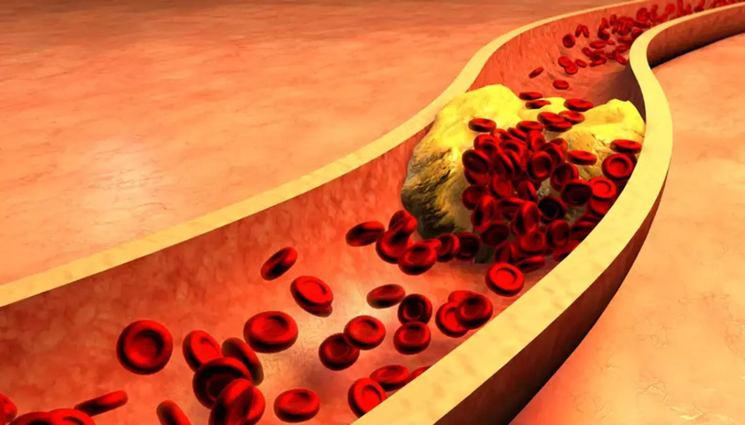 Chronic Occlusion Coronary Artery