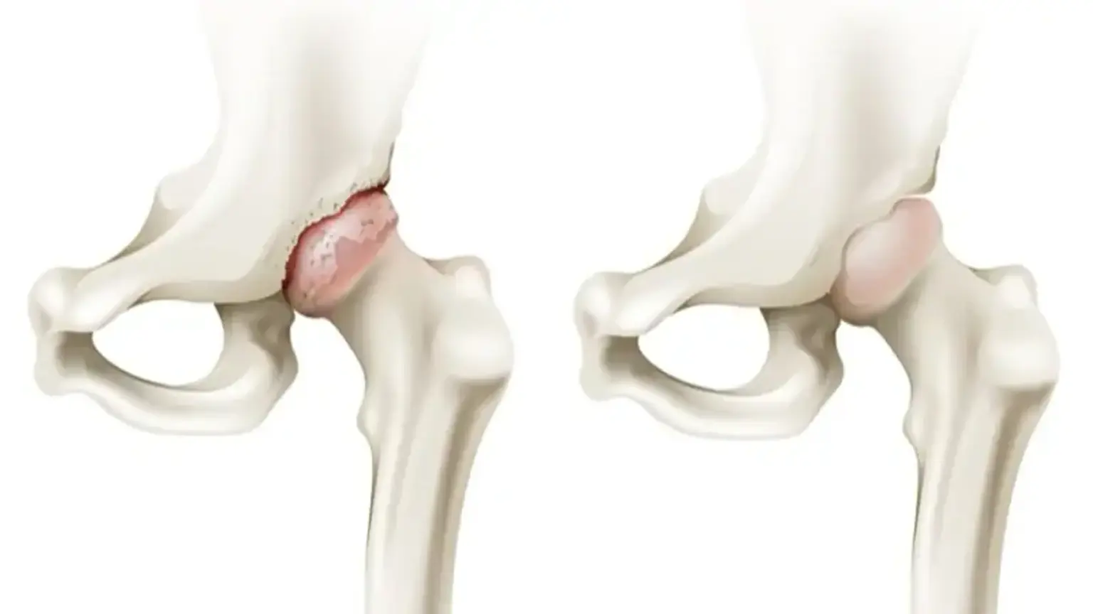 Hip Joint