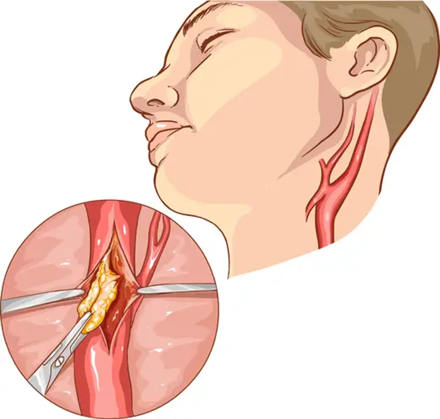 Carotid surgery