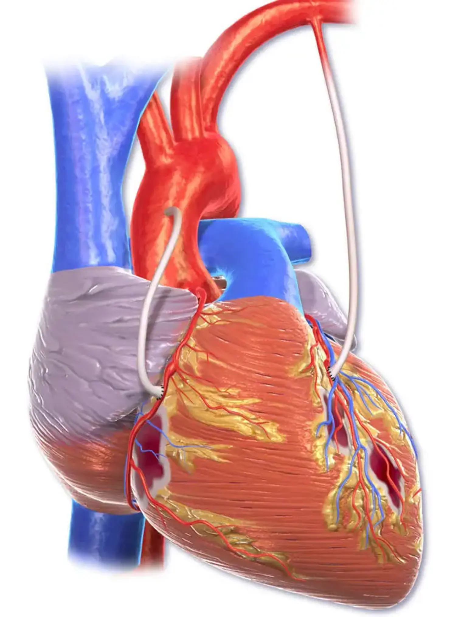 Coronary Artery Bypass Graft