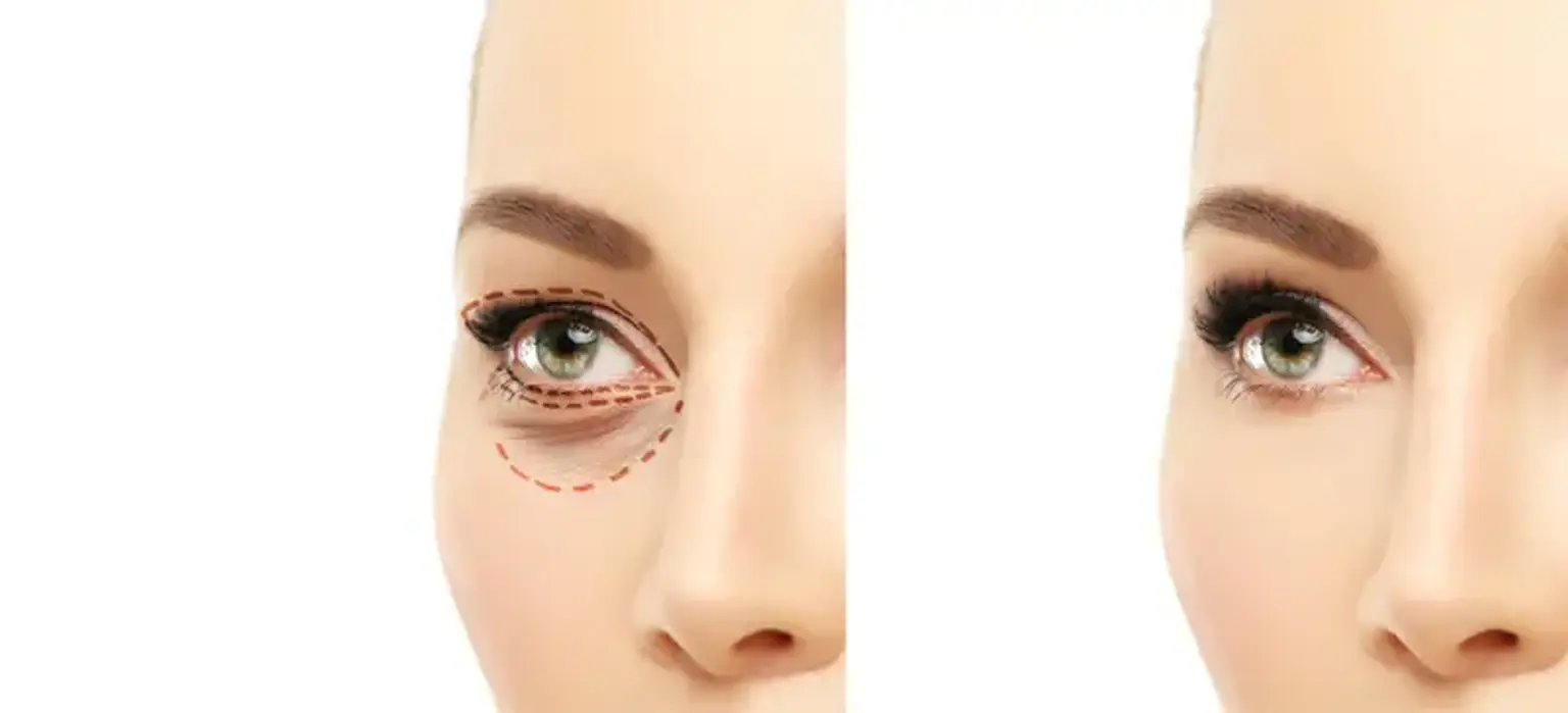 Blepharoplasty Kelopak Mata Bawah