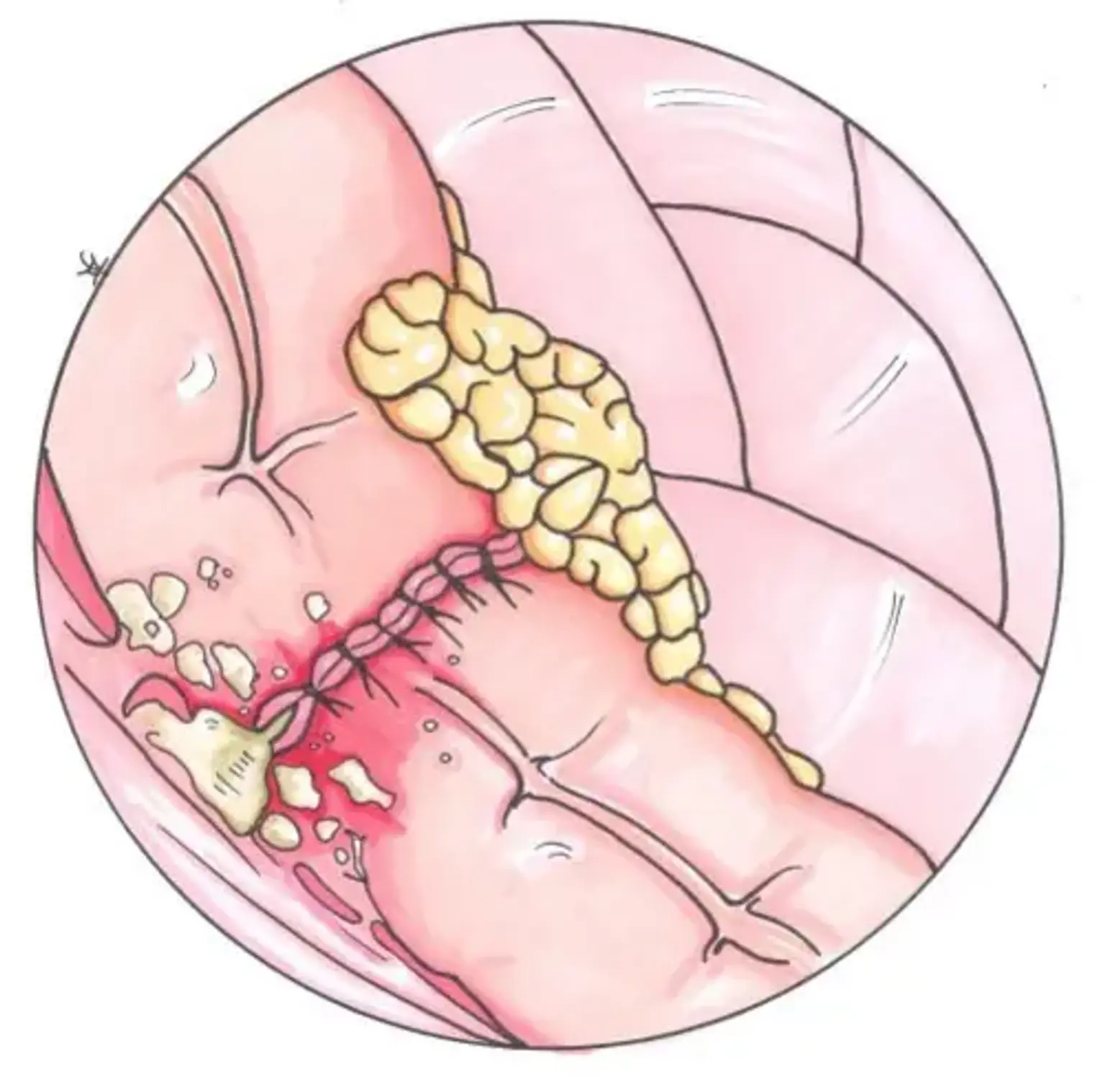 Anastomotic Leak