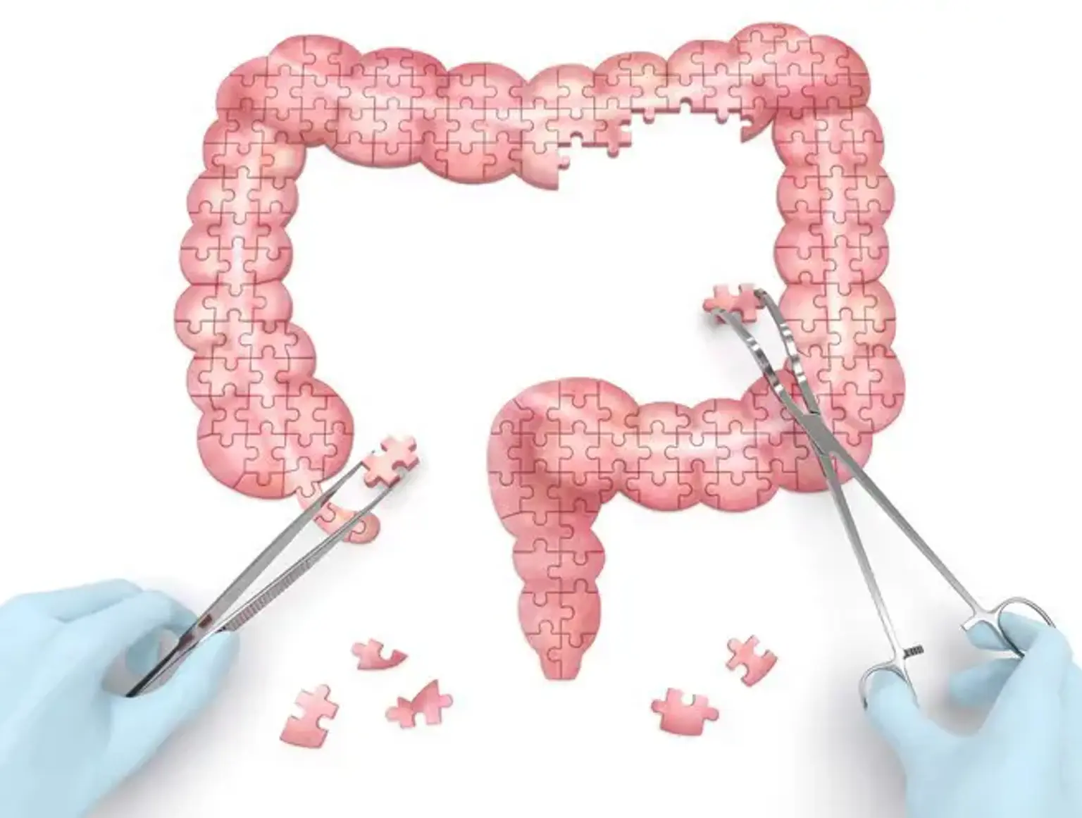 Large bowel resection