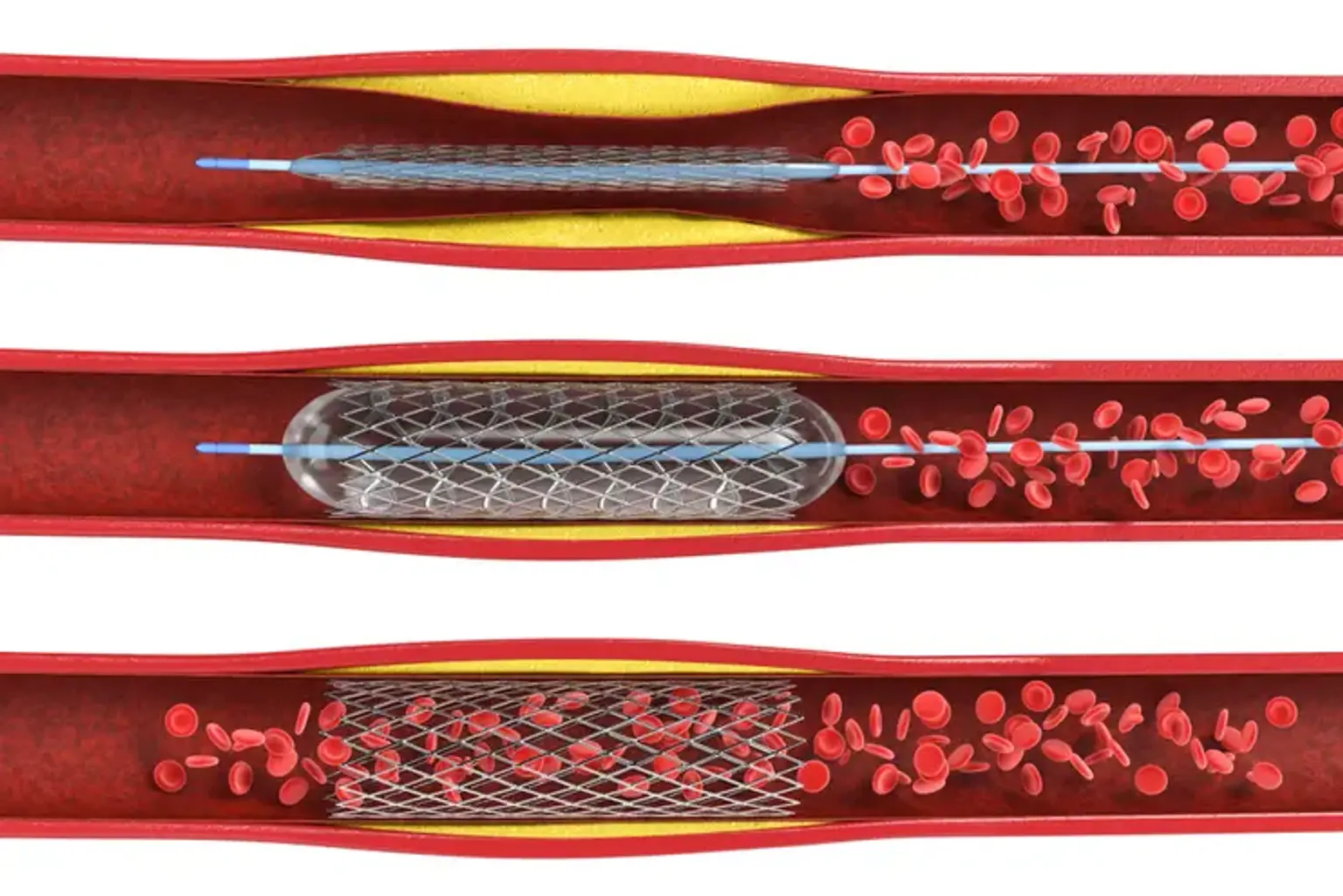 Invasive Cardiology