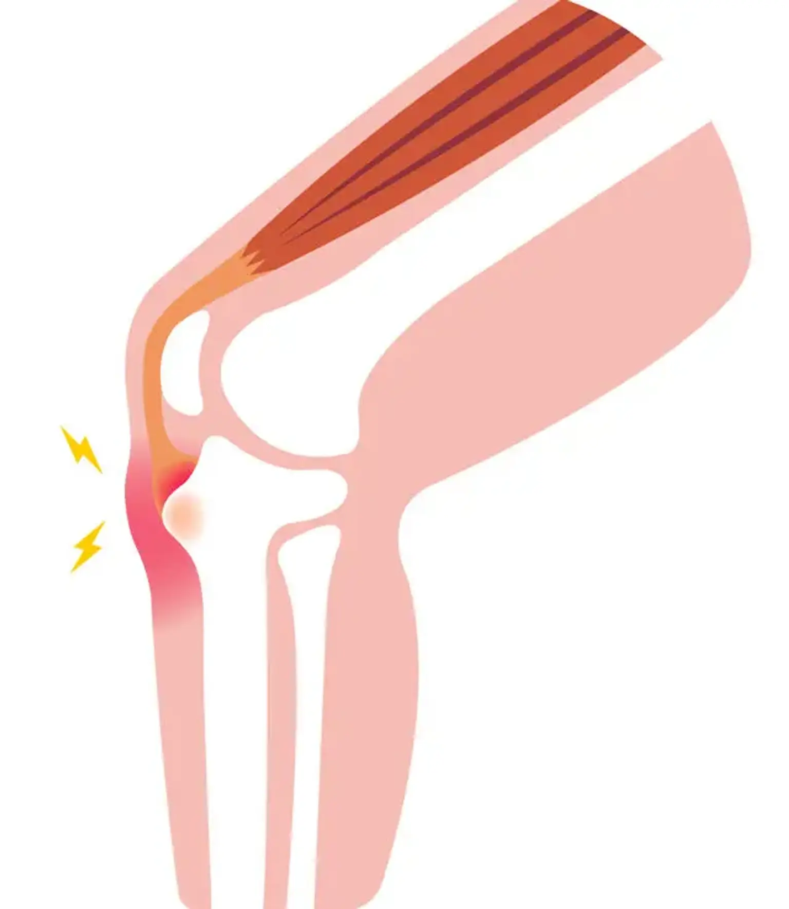 Osgood-Schlatter disease (OSD)