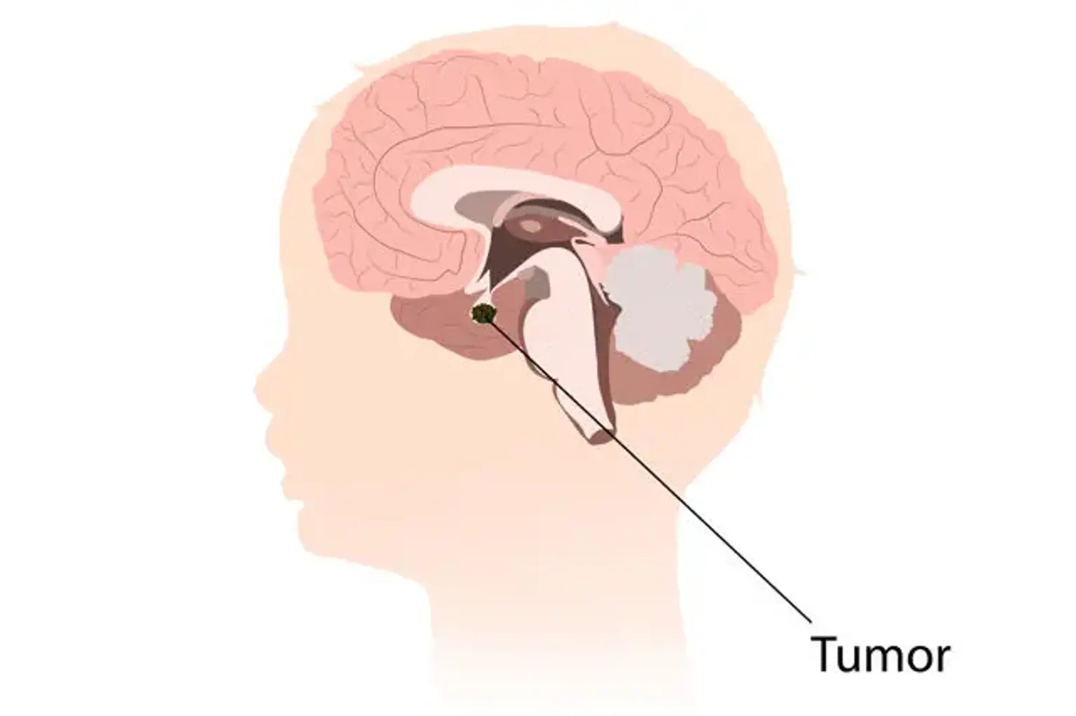 Craniopharyngioma