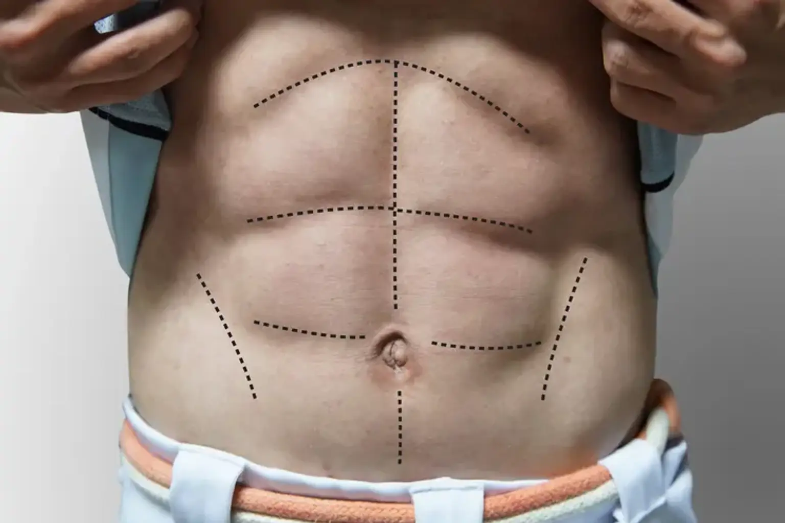 Male Abdomen Lipofit