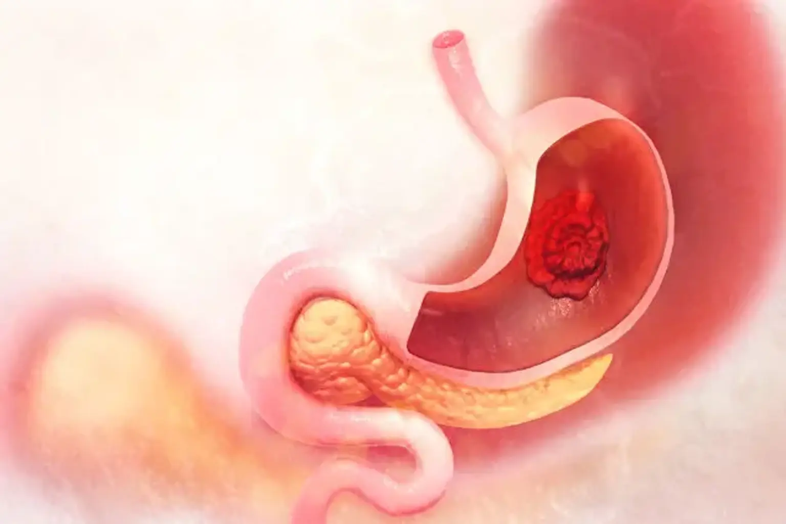 https://chblob.icloudhospital.com/imagecontainer/1-stomach-cancer-a81a4e31-9f1c-4b1d-97c5-80dec020f602.jpg