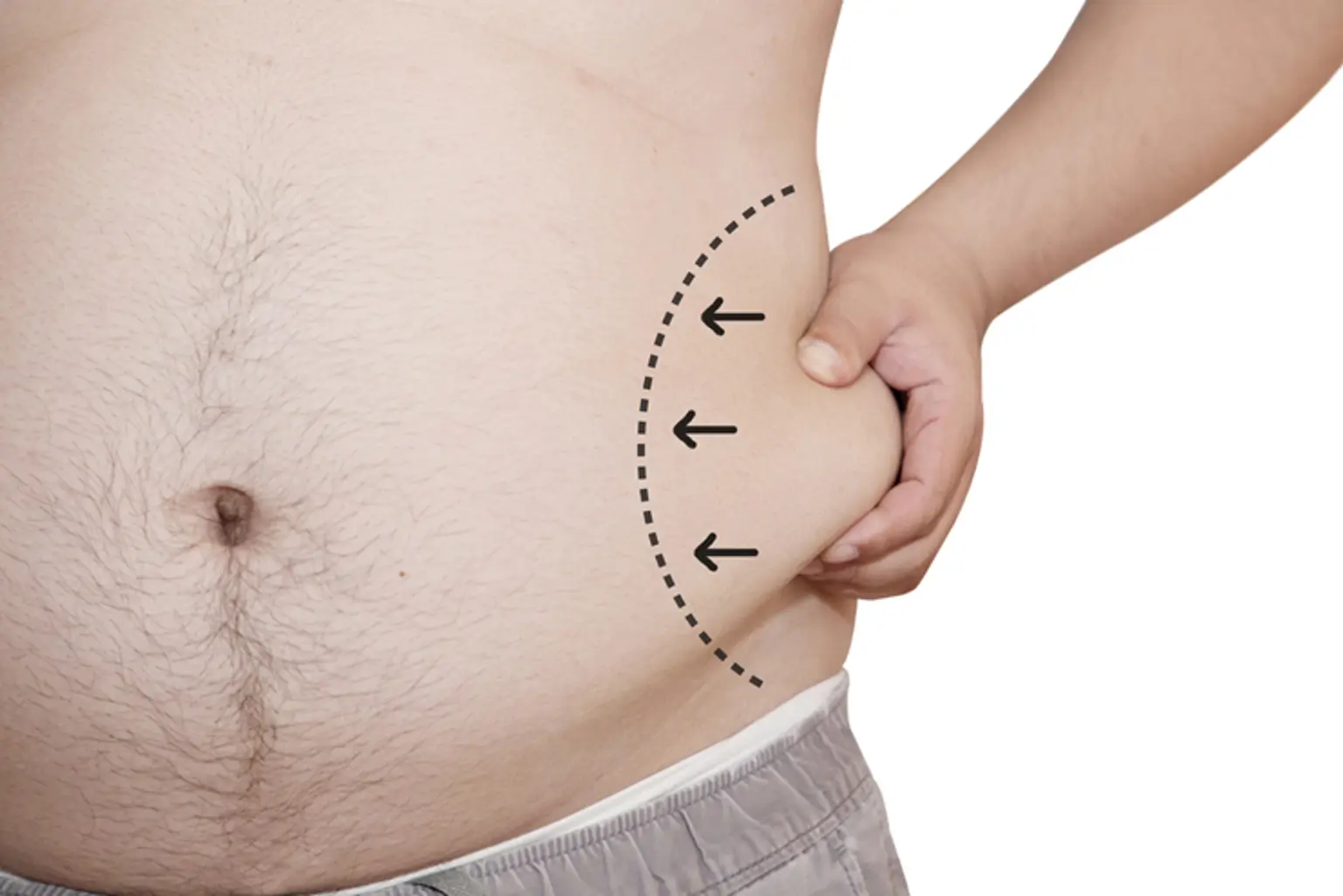 Liposuction