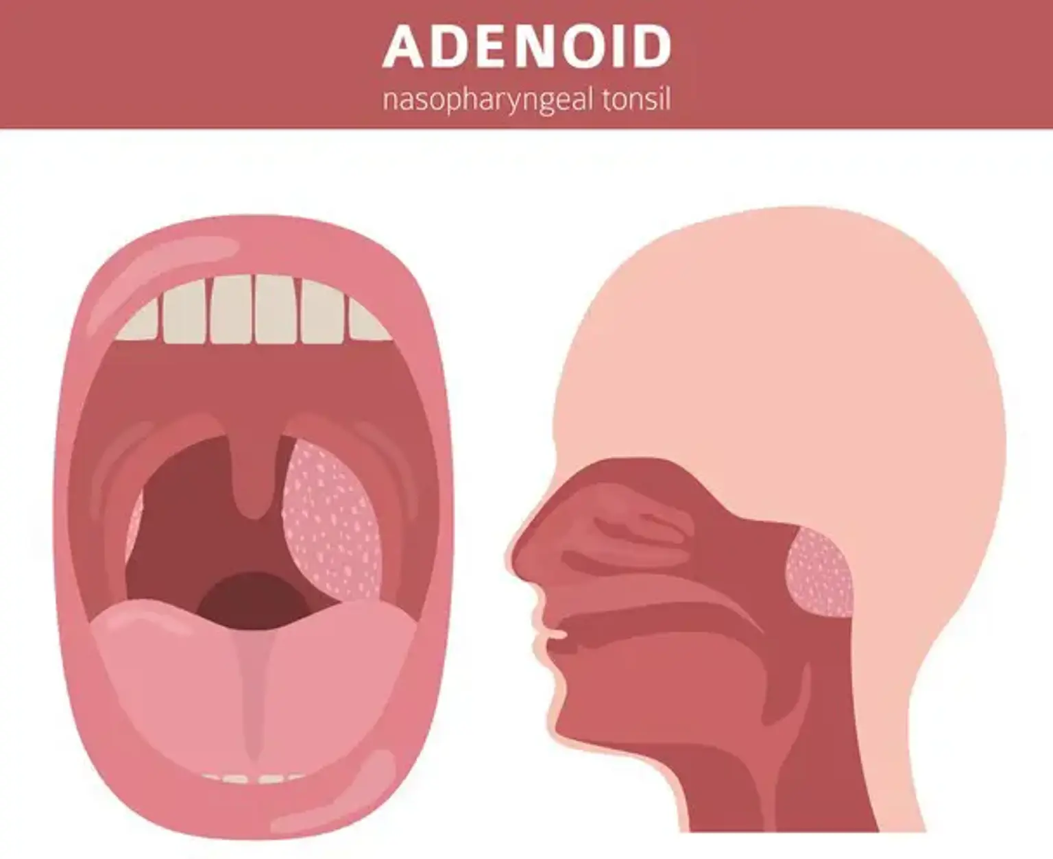 adenoids