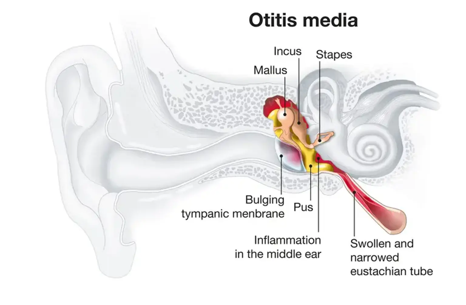 Otitis Media