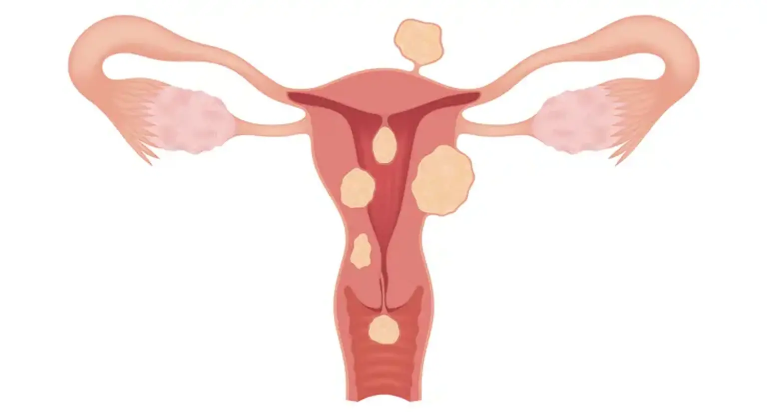 Uterine Fibroids