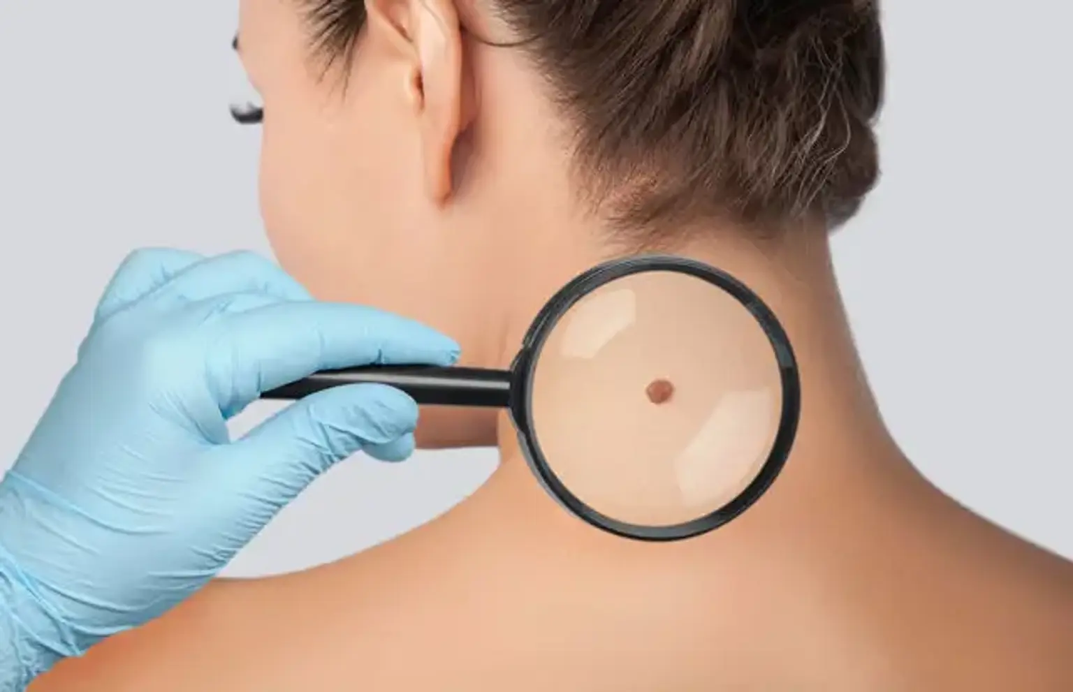 Moh surgery Definition